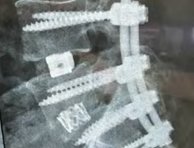 Wirbelsäule-Implantat-1b