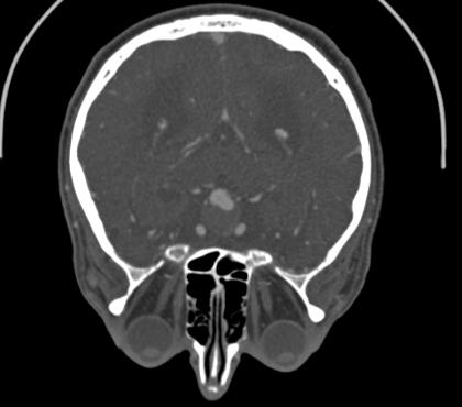 Axiales Schichtbild einer CT-Angiographie des menschlichen Kopfes