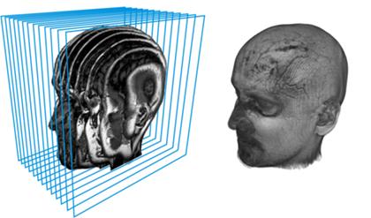 Rekonstruktion des dreidimensionalen Volumens aus tomographischen Schichtbildern